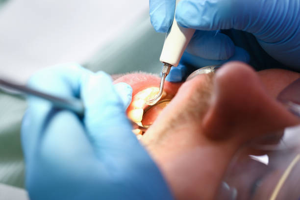 Best Knocked-Out Tooth (Avulsed Tooth) Treatment in Mcgraw, NY